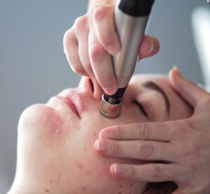 Diamond Microdermabrasion treatment for acne in Christchurch, Dorset