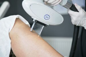 Get ready for summer 2023: Start your laser hair removal treatment