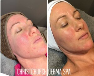 Rosacea before and after photos