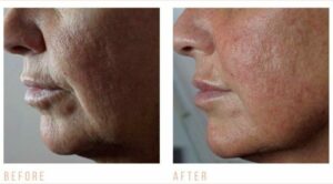 CACI jowl lift before and after photos